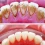 удаление зубов